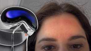 Γυναίκα που δοκίμασε το Apple Vision Pro για 30 λεπτά έμεινε με σημάδια στο πρόσωπο