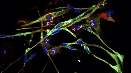 Ερευνητές μετέτρεψαν καρκινικά κύτταρα σε μυϊκά