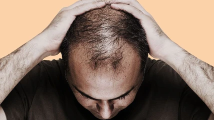 Επιστήμονες κατάφεραν να θεραπεύσουν την απώλεια μαλλιών με επαναστατική ανακάλυψη!