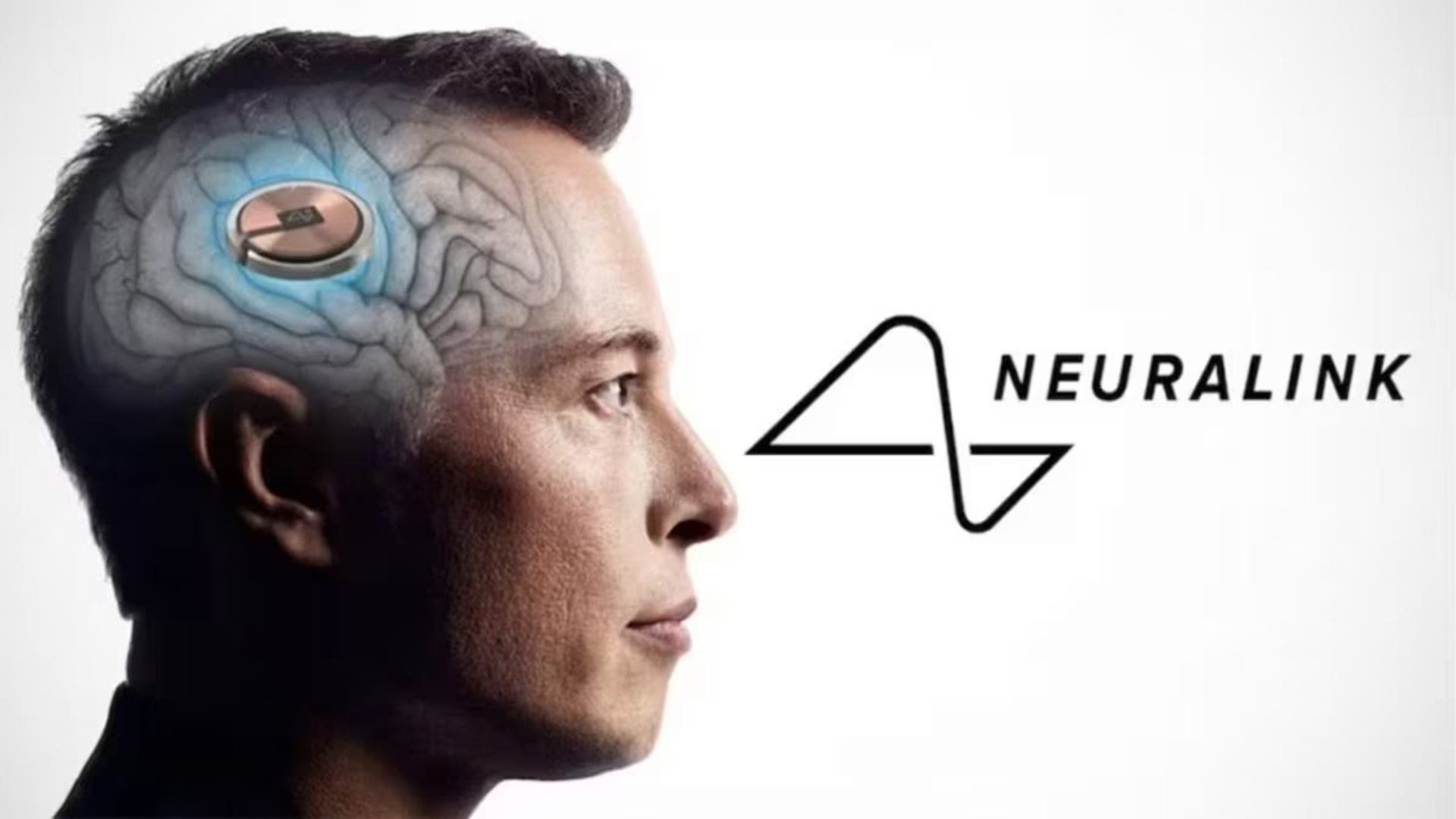 Η Neuralink εμφύτευσε τη συσκευή της σε δεύτερο ασθενή